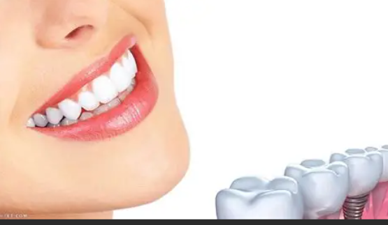 مستقبل تقويم الأسنان: التقويم الشفاف